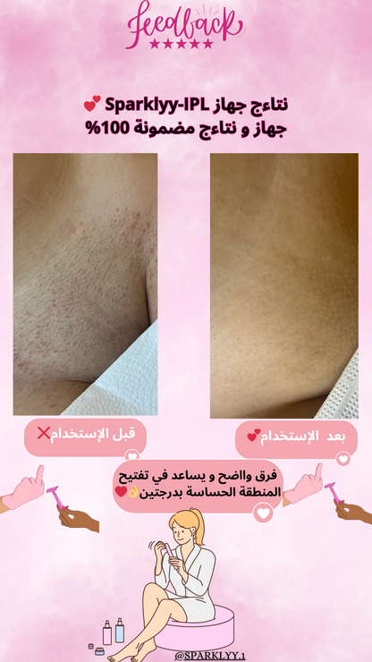 Sparklyy-IPL home laser hair removal device