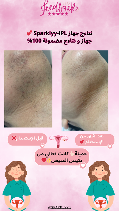 Sparklyy-IPL home laser hair removal device